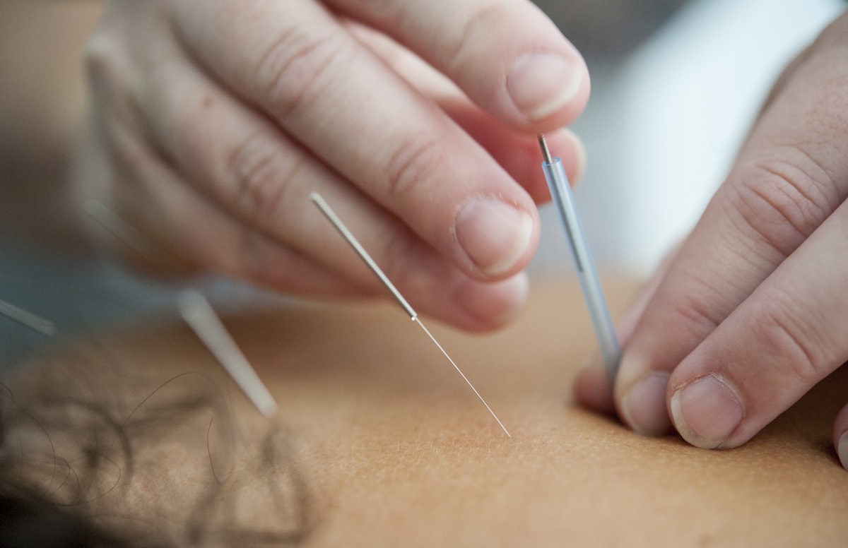 Agujas de acupuntura aplicadas durante una terapia